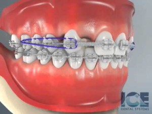 Incisives maxillaires latérales absentes (solution ortho prothétique)